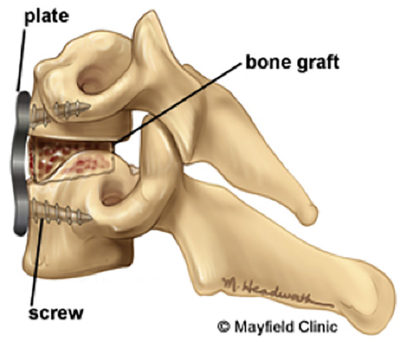 Anterior Cervical Fusion: Restoring Stability and Relieving Pain in the Neck