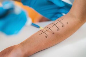 Allergy Testing: Types, Process, and What Your Results Mean