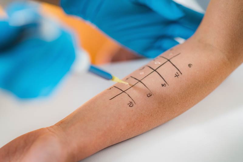 Allergy Testing: Types, Process, and What Your Results Mean