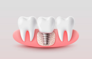 Say Goodbye to Dental Anxiety with Texas Sedation Dental Solutions
