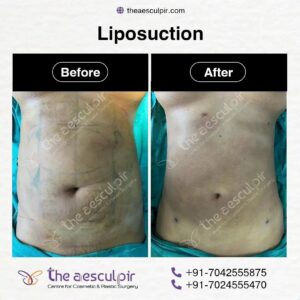 Discover Affordable Liposuction Surgery Cost in India with the Best Plastic Surgeon at Theaesculpir