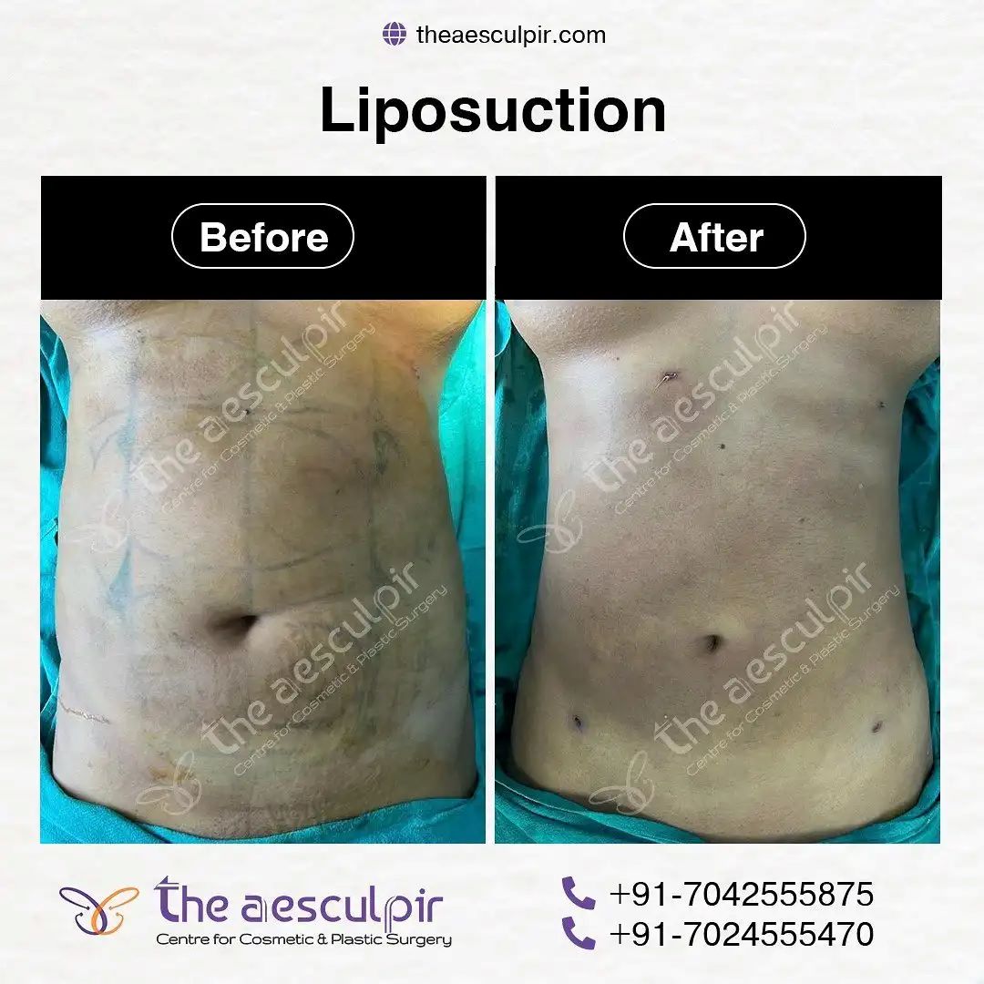 Discover Affordable Liposuction Surgery Cost in India with the Best Plastic Surgeon at Theaesculpir