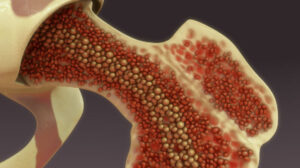 best bone marrow transplant in India