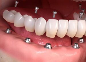 Sorrisi Perfetti con Ortodonzia Invisibile Albania: La Scelta Moderna per la Cura Dentale