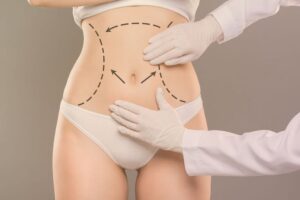 Tummy Tuck Surgery in Dubai – Your Path to a Confident You
