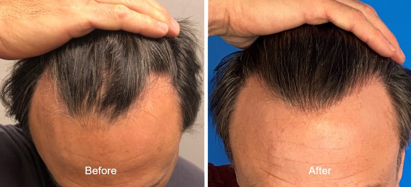 Affordable and Reliable Hair Transplant Packages Albania for UK Residents