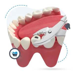 Root Canal vs. Teeth Extraction: A Clinical Comparison
