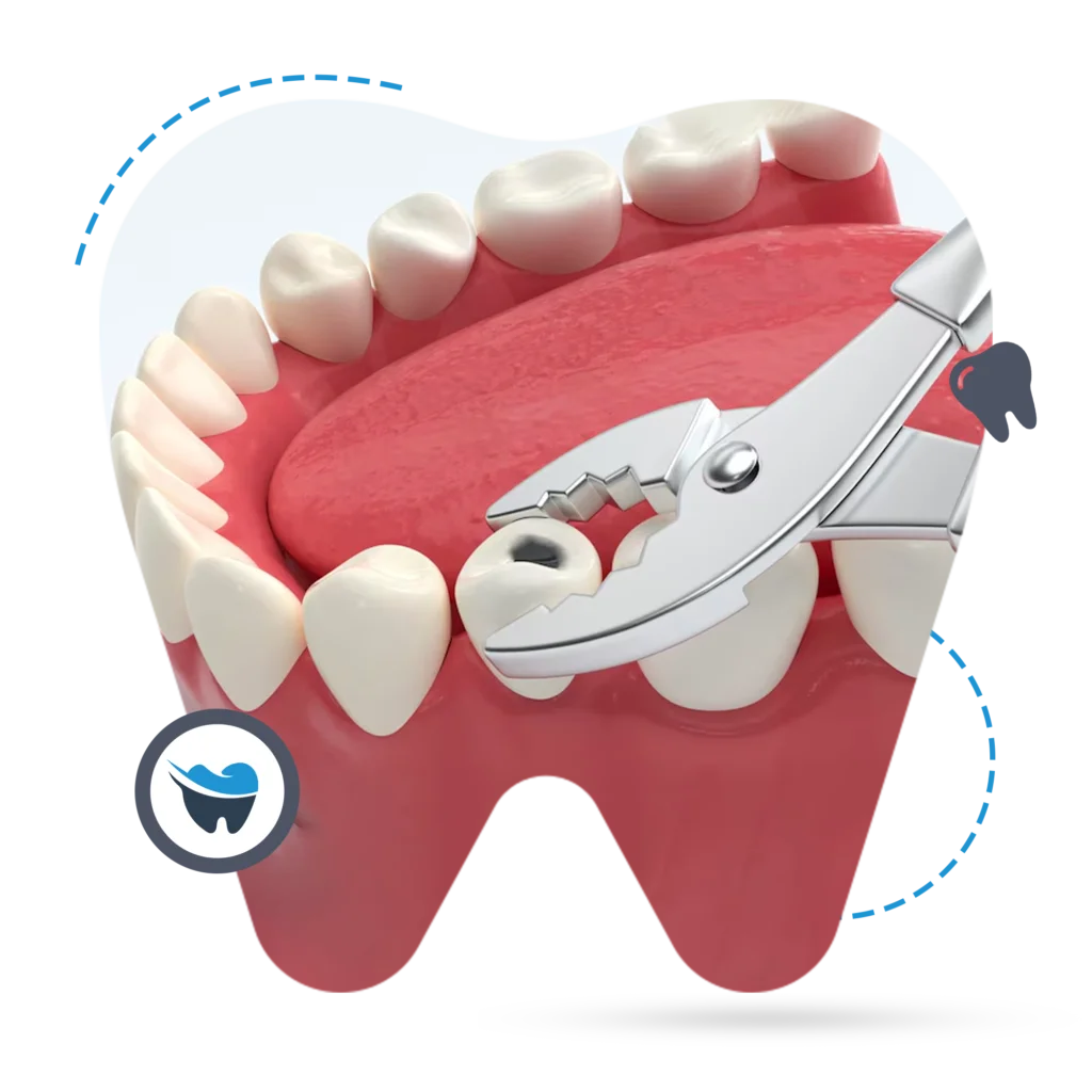 Root Canal vs. Teeth Extraction: A Clinical Comparison