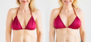 Is Augmentation Mammoplasty Right for You? Key Considerations Before Surgery