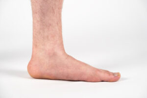 Podiatrists in Edinburgh Treat Flat Feet and Related Foot Disorders