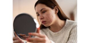 How to Choose the Right Skincare Products for Acne
