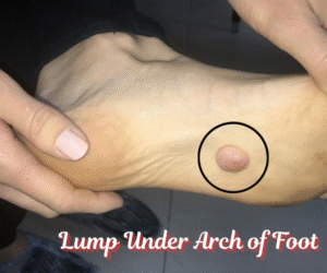 Lump Under Arch of Foot