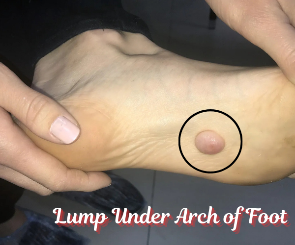 Painful Lump Under Arch of Foot? Causes and Treatments You Should Know