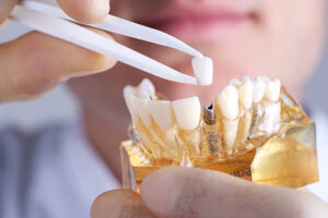 What You Should Know Before Choosing Dental Implants in Broward County