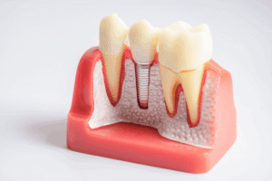 Reliable Dental Implants Aberdeen  Improve Function and Confidence