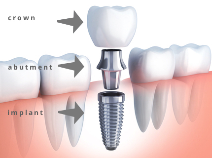 The Best Dental Implant Aberdeen for Missing Teeth Replacement