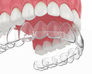 Best Invisalign Clear Aligners Aberdeen for Adults and Teens