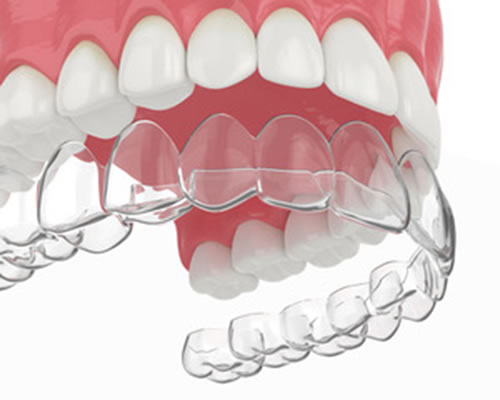 Best Invisalign Clear Aligners Aberdeen for Adults and Teens